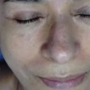 Limpieza facial profunda