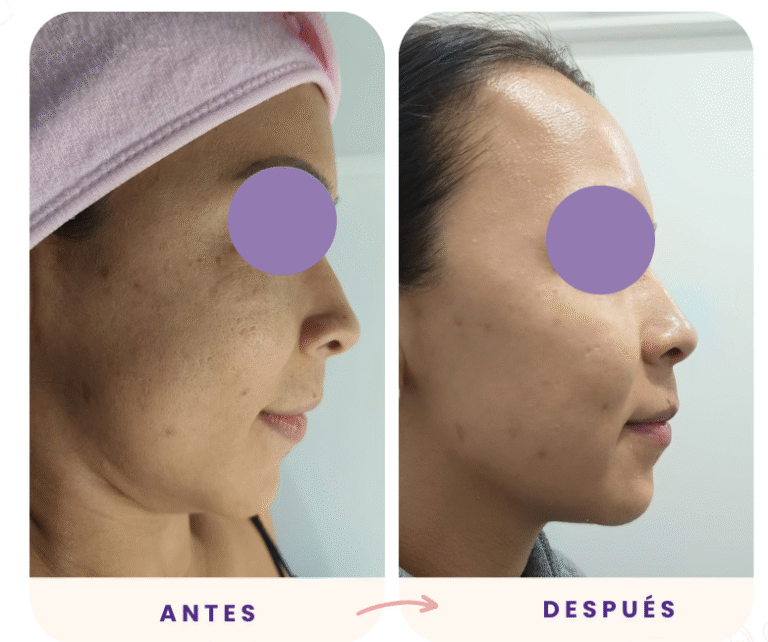 Limpieza facial gold