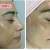 Despigmentación facial Cali