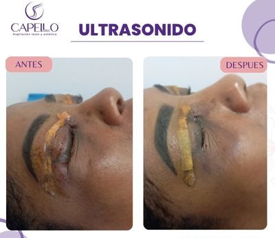 Ultrasonido