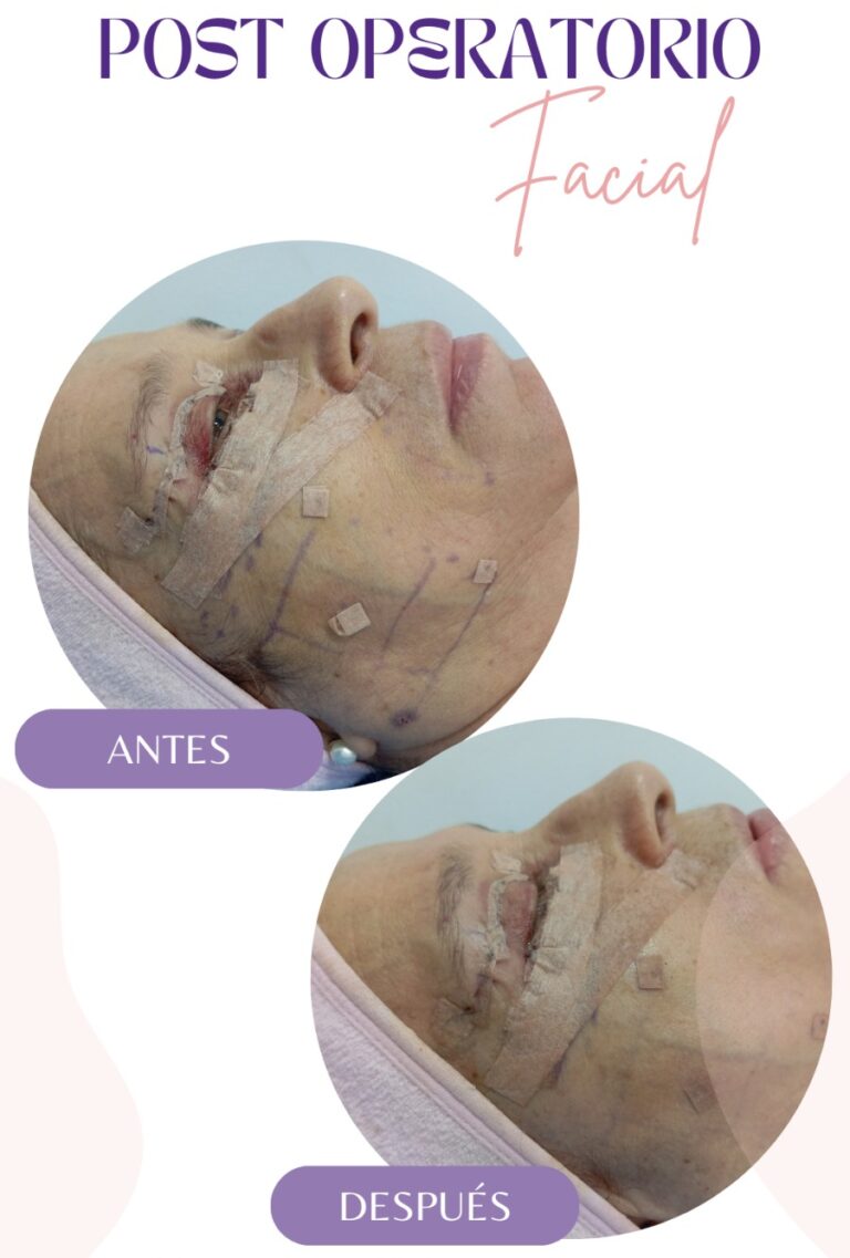 Postquirúrgico facial