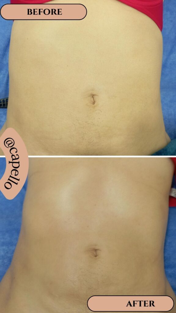 Recuperación postquirúrgica en Cali: abdomen antes y después del tratamiento postoperatorio en Capello