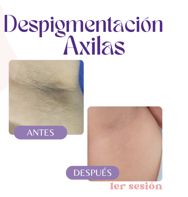 Despigmentación axilas