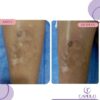 Depilación Láser y estética facial y corporal cali