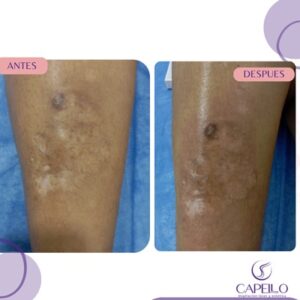 Depilación Láser y estética facial y corporal cali