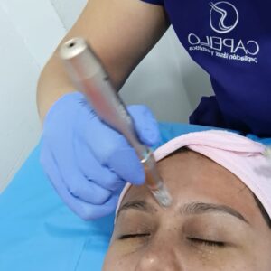 Despigmentación facial