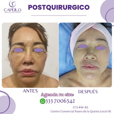Postoperatorio facial